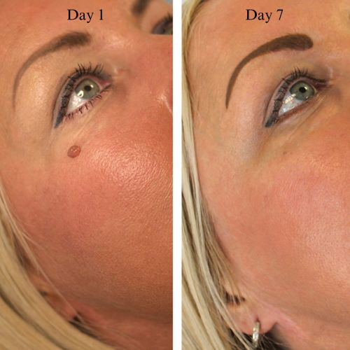 AluraTag™ - Pregnancy Safe Skin Tag Removal Kit