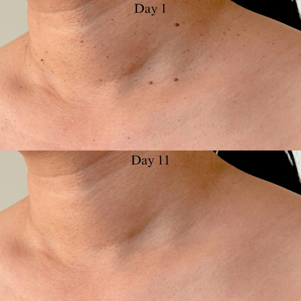 AluraTag™ - Pregnancy Safe Skin Tag Removal Kit