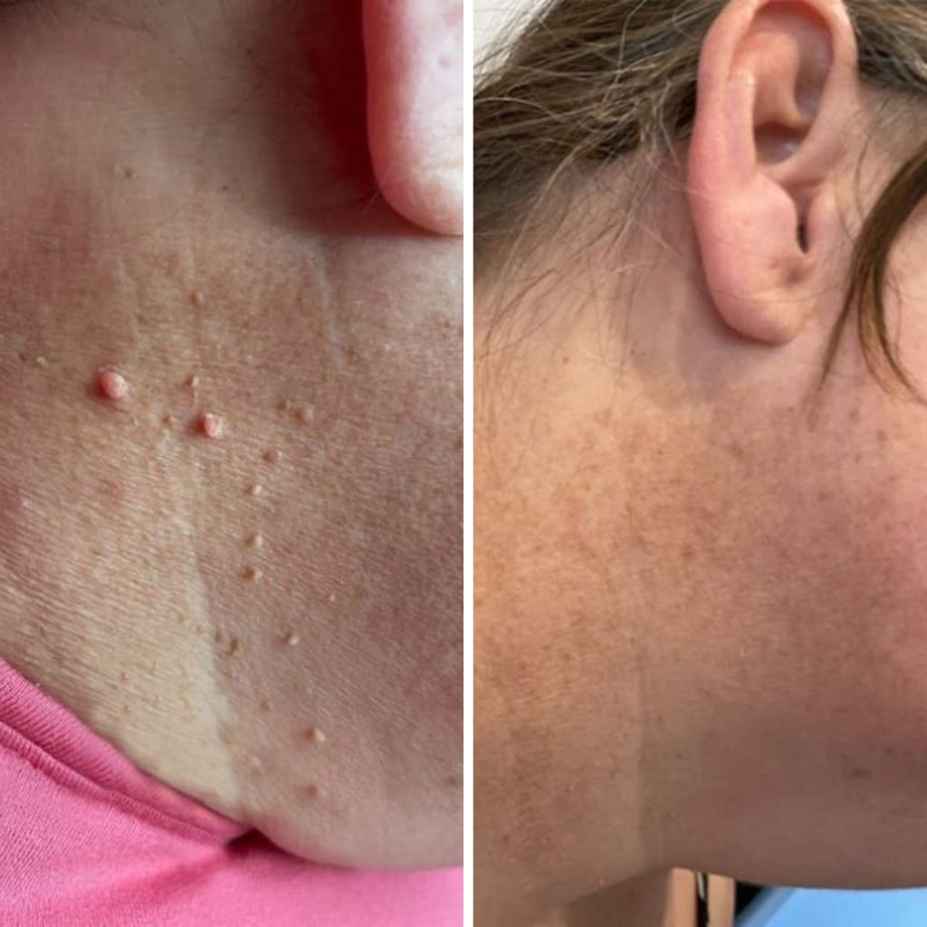 AluraTag™ - Pregnancy Safe Skin Tag Removal Kit