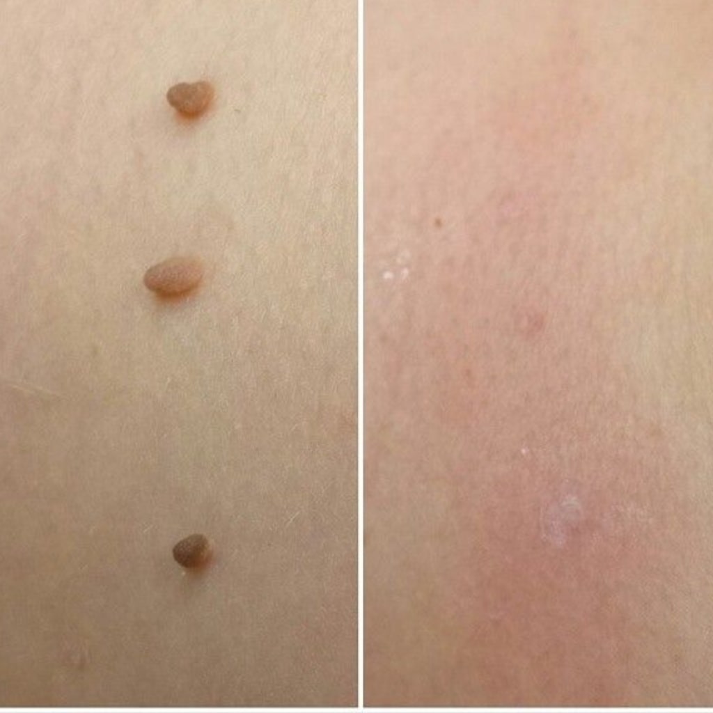 AluraTag™ - Pregnancy Safe Skin Tag Removal Kit