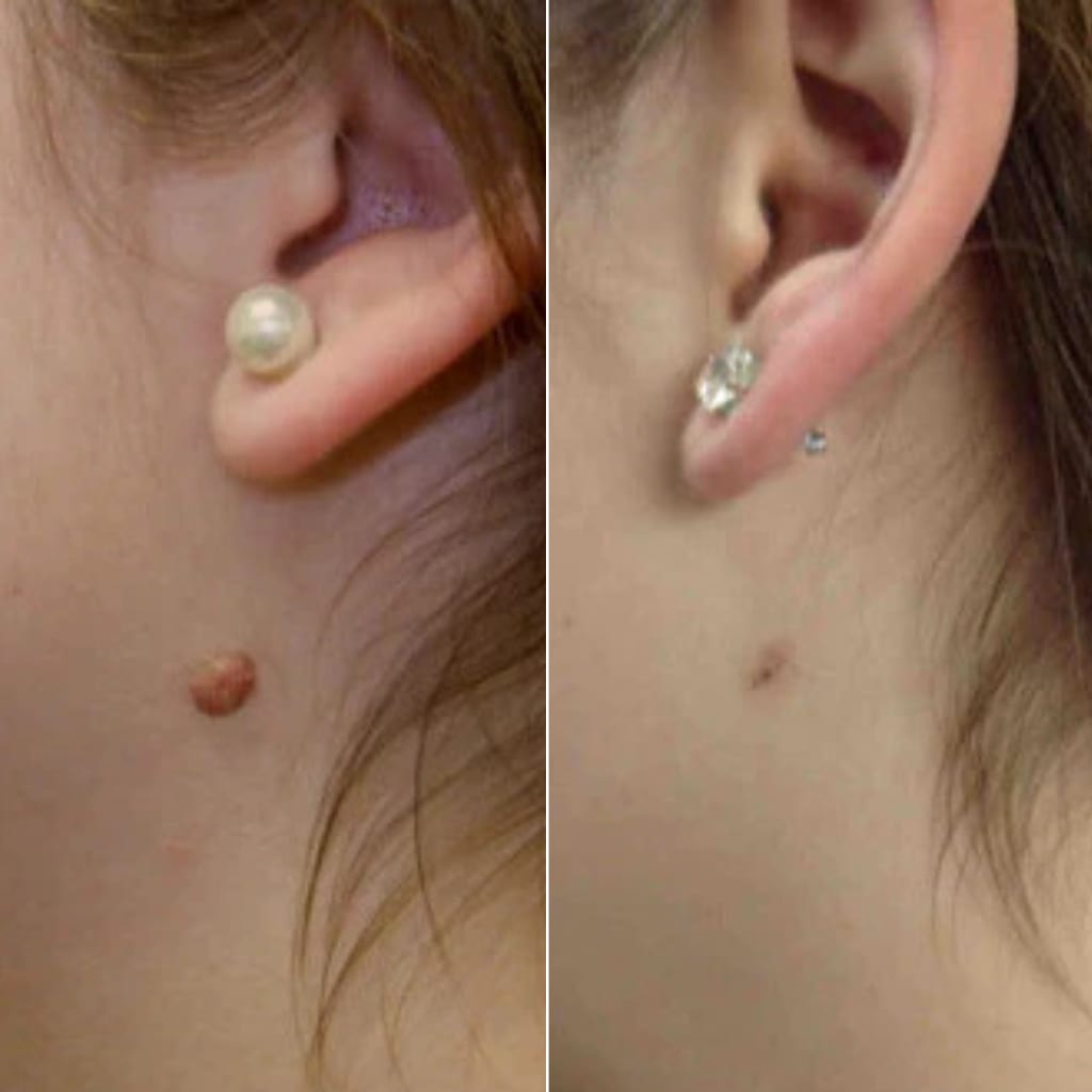 AluraTag™ - Pregnancy Safe Skin Tag Removal Kit